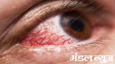 mucor-mycosis-amravati-mandal