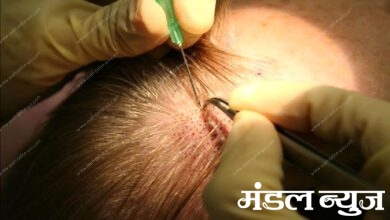 hair-transplantation-amravati-mandal