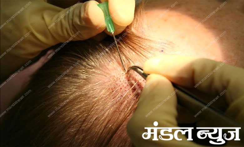 hair-transplantation-amravati-mandal